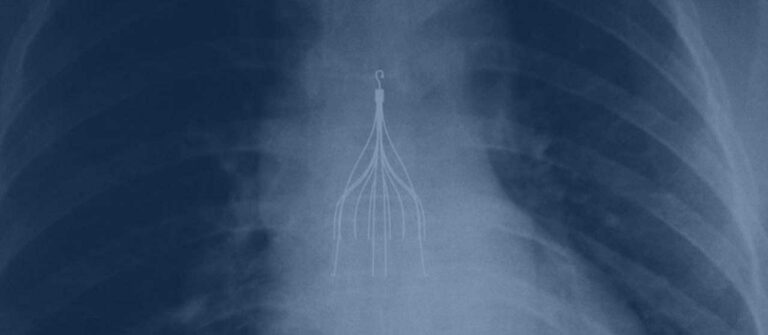 IVC Filter-Manufacturers-fault