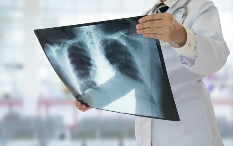 doctor looking at lung xray