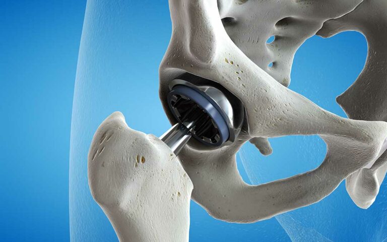graphic of hip replacement