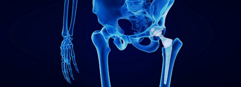 Hip Replacement Lawsuits