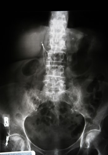 ivc filter