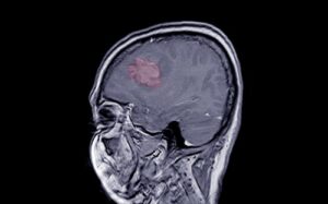 MRI of Meningioma