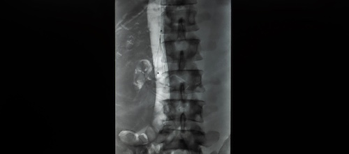 IVC Filter Lawsuits Complications
