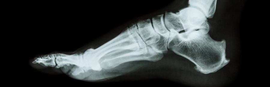 An X-ray of a foot with an implant represents a Cartiva implant lawsuit.