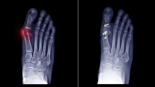Foot imaging before and after to represent evidence for a Cartiva implant lawsuit.